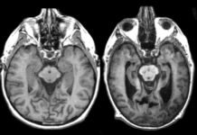 Las enfermedades priónicas: cuando las proteínas alteradas devastan el sistema nervioso