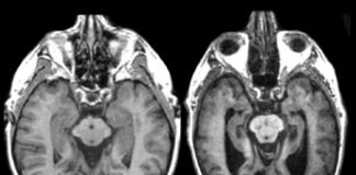 Las enfermedades priónicas: cuando las proteínas alteradas devastan el sistema nervioso