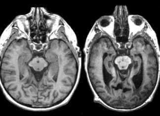 Las enfermedades priónicas: cuando las proteínas alteradas devastan el sistema nervioso