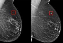 Dos productos químicos utilizados en cosméticos y cremas solares pueden favorecer el desarrollo del cáncer de mama