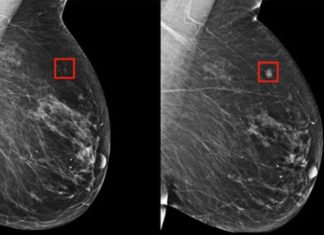 Dos productos químicos utilizados en cosméticos y cremas solares pueden favorecer el desarrollo del cáncer de mama