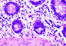 Descubren una célula inmune que abre la puerta a la «cura universal» para el cáncer