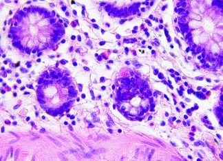 Descubren una célula inmune que abre la puerta a la «cura universal» para el cáncer