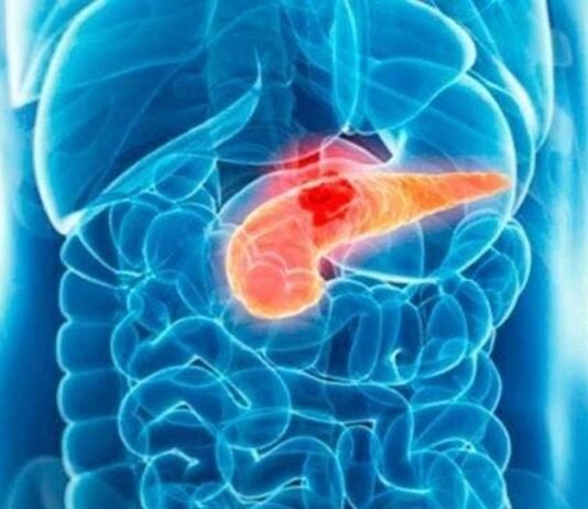 El cáncer de páncreas podría obtener tratamiento a raíz de una investigación liderada en Barcelona