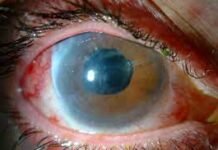 Los hospitales valencianos realizaron más de 1.200 intervenciones de glaucoma a través de cirugía ambulatoria en 2021