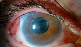 Los hospitales valencianos realizaron más de 1.200 intervenciones de glaucoma a través de cirugía ambulatoria en 2021